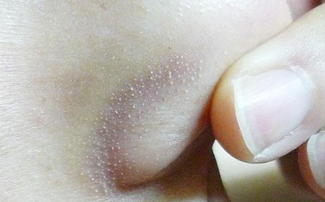 Mẹo hay giúp loại sạch mụn cám trên da