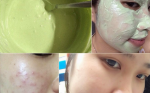 Bí quyết dưỡng trắng da trị mụn với bột trà xanh nguyên chất