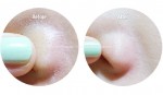 3 công thức đánh bay mụn cám tận gốc chỉ với 20 phút