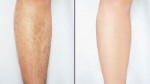 10 điều cần biết để triệt lông chân vĩnh viễn tại nhà