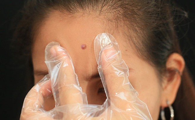Cách nặn mụn không để lại sẹo thâm