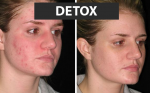 7 bước giải độc giúp mụn lặn đi nhanh chóng