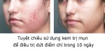 Tuyệt chiêu sử dụng kem trị mụn để điều trị dứt điểm chỉ trong 10 ngày