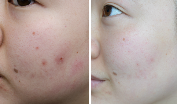 Chỉ tốn 5.000 VNĐ để đánh bay &rsquo;1 tá&rsquo; mụn hiệu quả