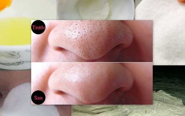 Lột mụn đầu đen siêu dễ bằng lòng trắng trứng gà