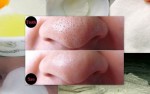 Lột mụn đầu đen siêu dễ bằng lòng trắng trứng gà
