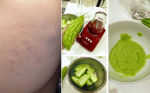 Mẹo đẩy mụn ẩn với mặt nạ mưới đắng hiệu quả