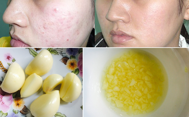 Mẹo trị mụn tại nhà với tỏi cực hiệu quả