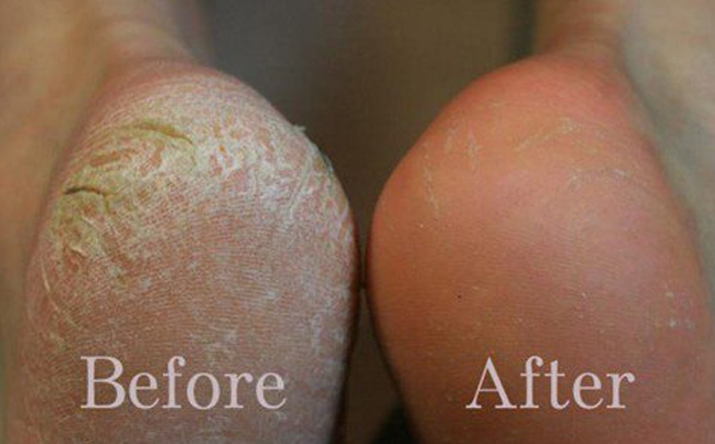 Mẹo hay giúp gót chân mịn màng, ngừa khô nứt hiệu quả