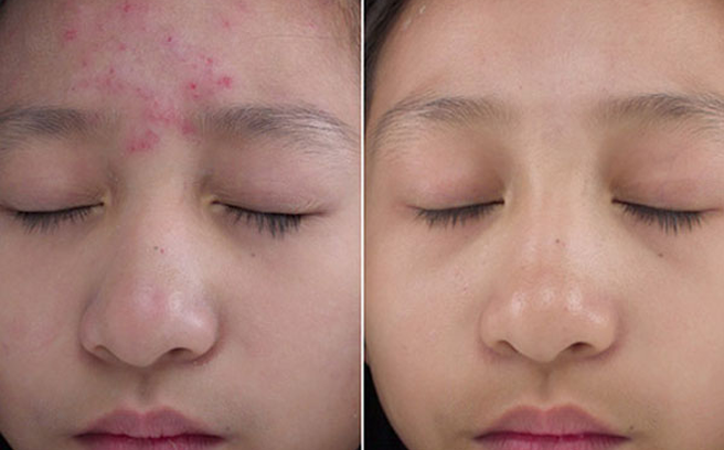 Mẹo hay giúp trị mụn tại nhà chỉ với Aspirin