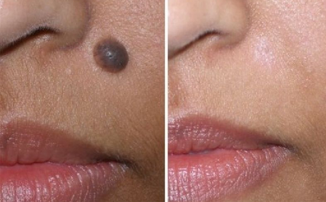 12 mẹo hay giúp loại bỏ nốt ruồi nhanh chóng tại nhà