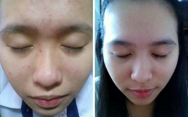 Nguyên nhân hình thành và bí quyết đánh bật mụn ẩn dưới da