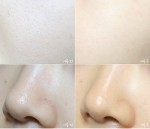 Xóa bỏ nỗi ám ảnh mang tên lỗ chân lông to vĩnh viễn